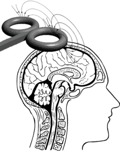 Transcranial Magnetic Stimulation Claims